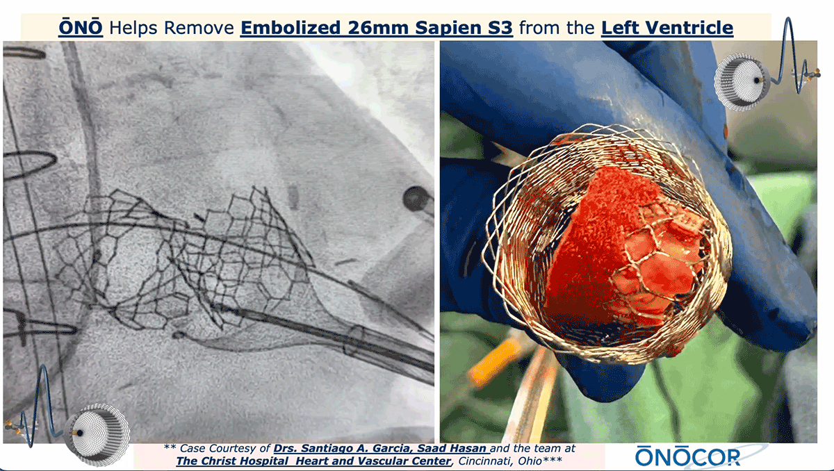 Preview image for Edwards Sapien S3 removed from Left Ventricle with ŌNŌ