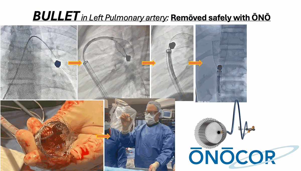 Preview image for Bullet removal from Left Pulmonary Artery_December 2024