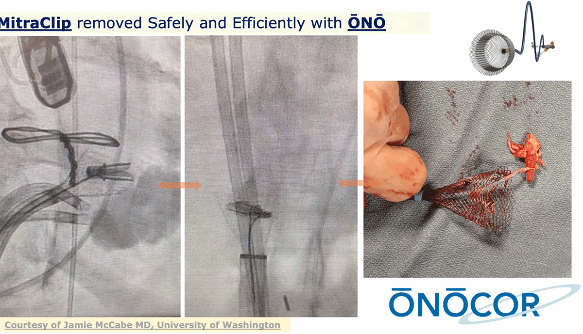Preview image for MitraClip Rremoval with ŌNŌ followed by TMVR with Edwards M3
