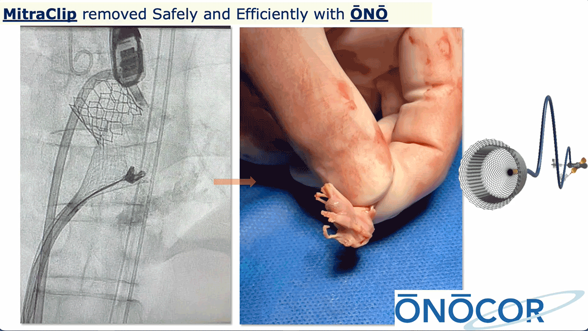 Preview image for MitraClip Rremoval with ŌNŌ followed by TMVR with Edwards M3