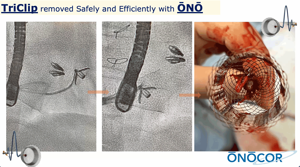 Preview image for TriClip removal with ŌNŌ