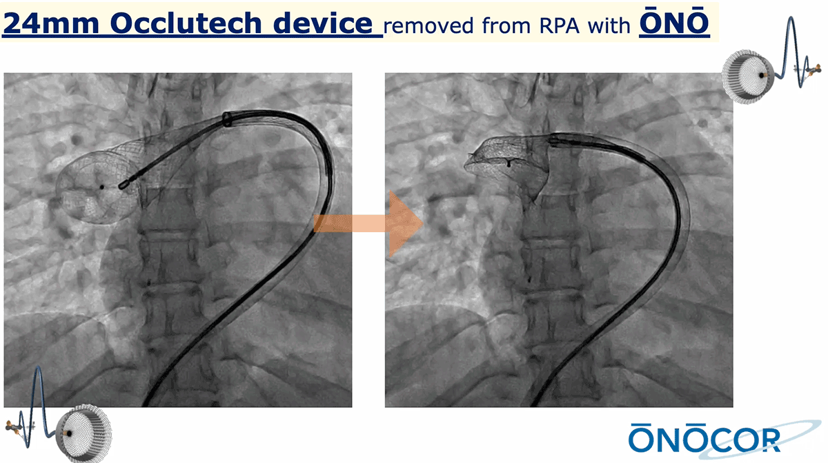 Preview image for 24mm Occlutech ASD Occluder removed from Right Pulmonary Artery with ŌNŌ