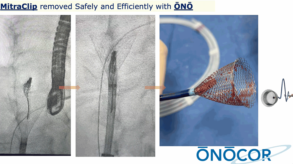 Preview image for MitraClip removal with ŌNŌ