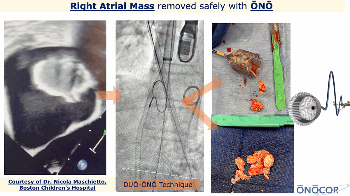 Preview image for Right Atiral mass removed with ŌNŌ_BCH