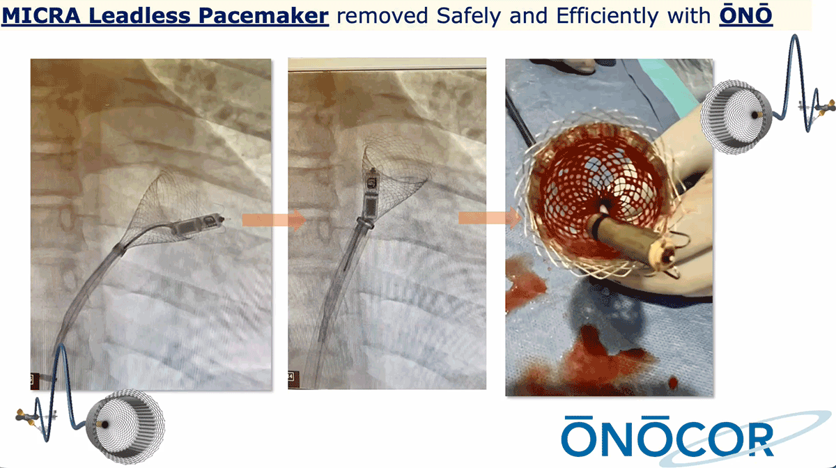 Preview image for MICRA Leadless Pacemaker Removal from RV with ŌNŌ