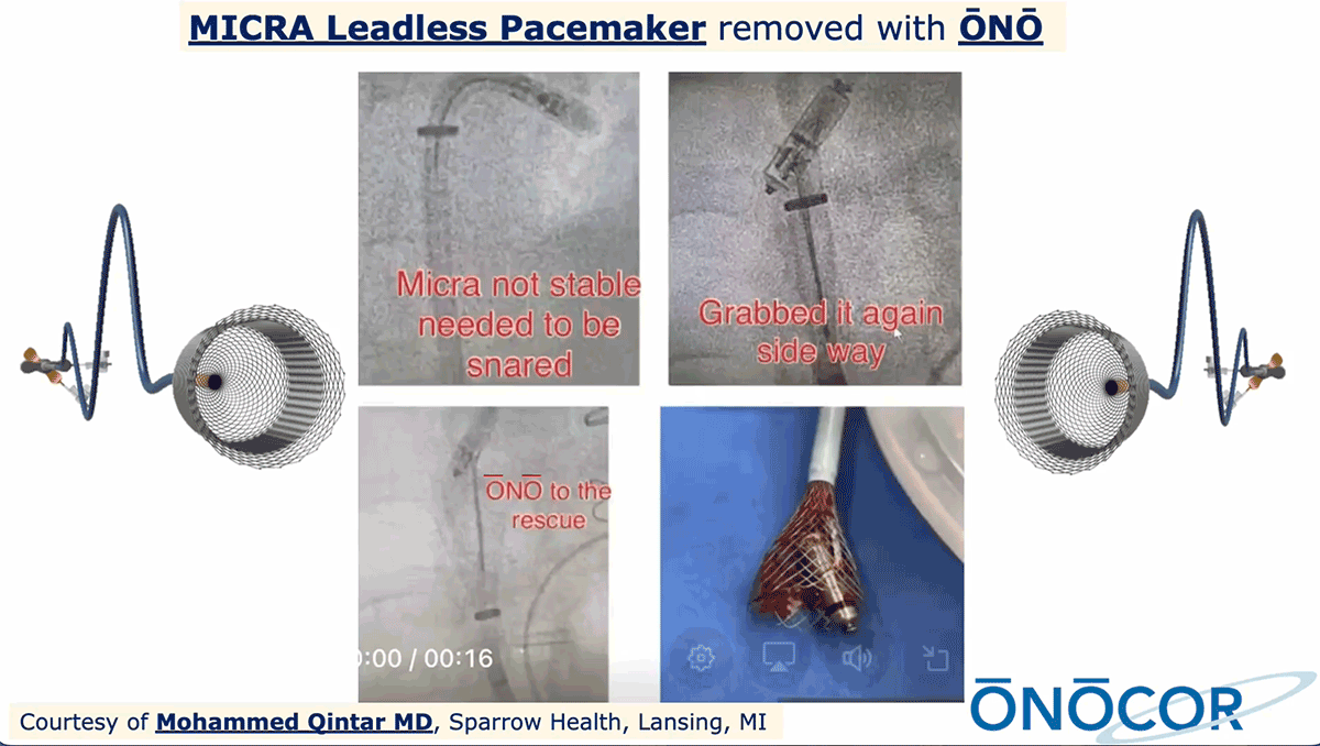 Preview image for MICRA Leadless Pacemaker Removal from Pulmonary Artery with ŌNŌ