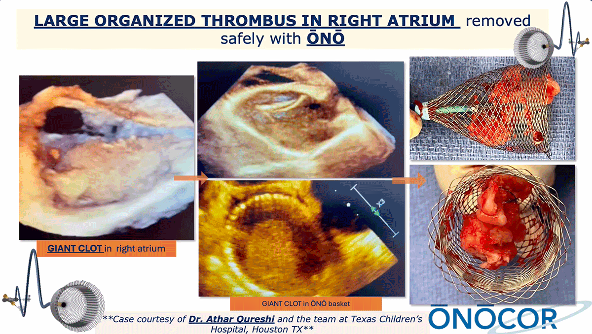 Preview image for Right Atrial clot removal with ŌNŌ_TCH