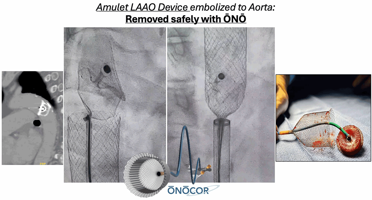 Abbott Amulet LAAO removed from Aorta with ŌNŌ.