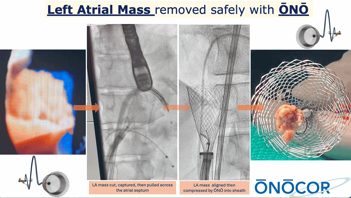 Preview image for Left Atrial mass removed with ŌNŌ_MN