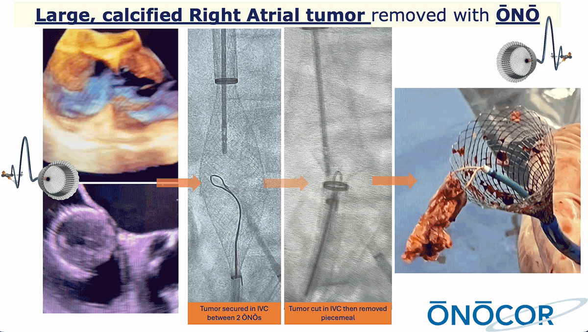 Preview image for Large Right Atrial Mass removed with 2 ŌNŌs- DUO-ŌNŌ
