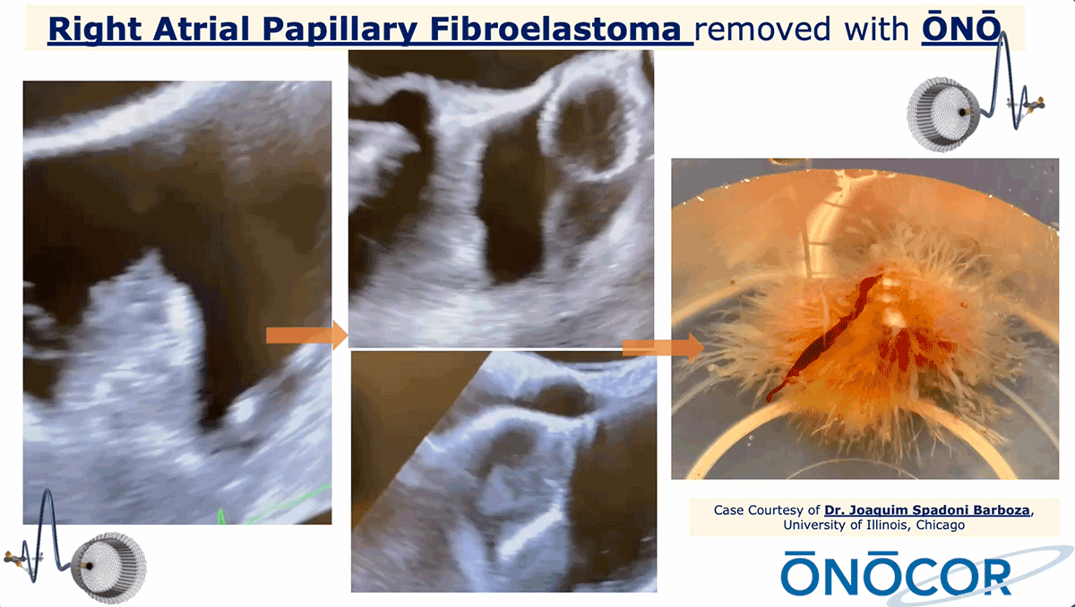 Preview image for Papillary Fibroelastoma (PFE) removal from Right Atrium with ŌNŌ