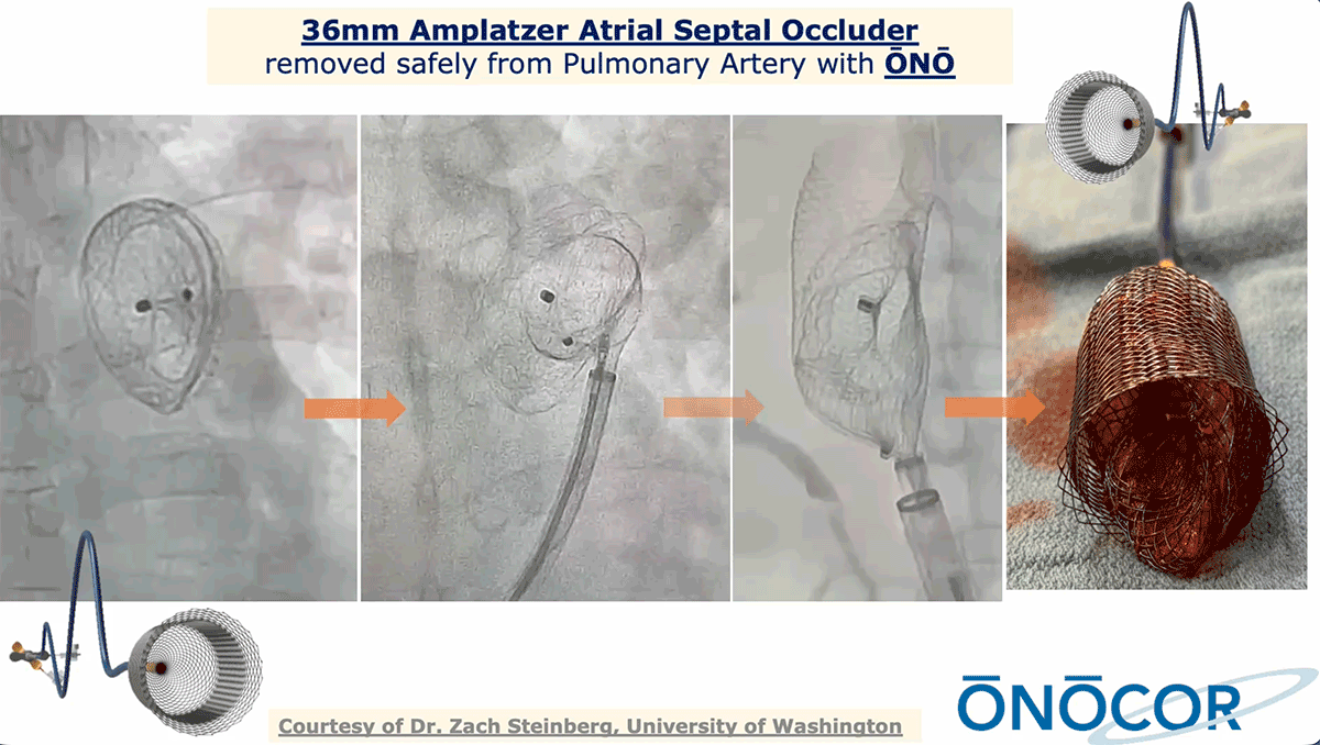 Preview image for 36mm ASO removal from MPA with ŌNŌ
