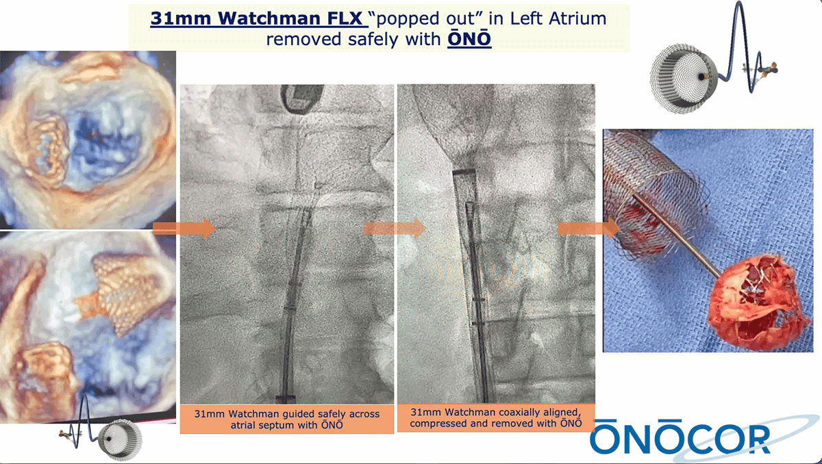 31mm Watchman removal from the Left Atrium