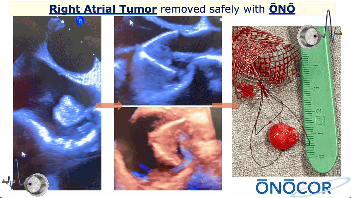 Preview image for Myxoma in Right Atrium removal with ŌNŌ