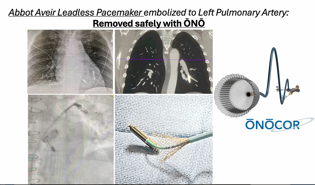 Abbott Aveir Leadless Pacemeker removed from Left Pulmonary Artery with ŌNŌ.