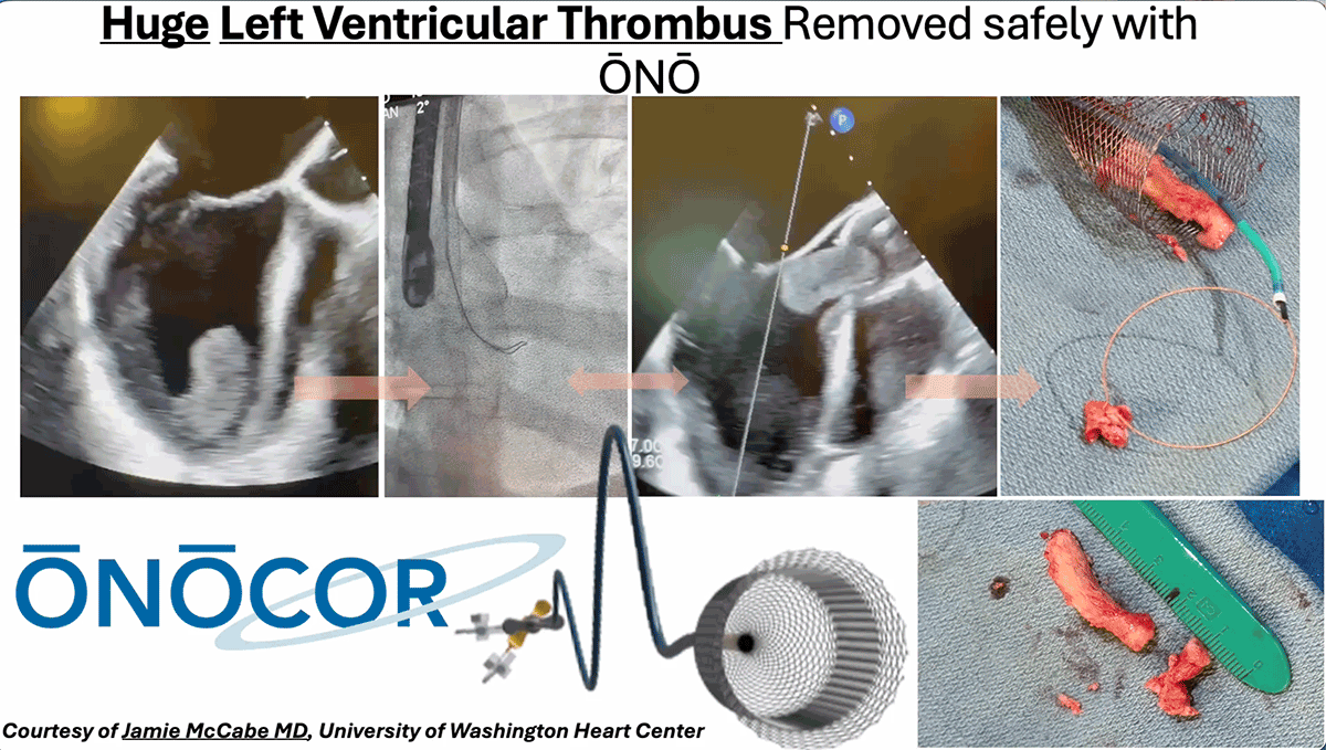 Left Ventricular Thombus Removal with ŌNŌ