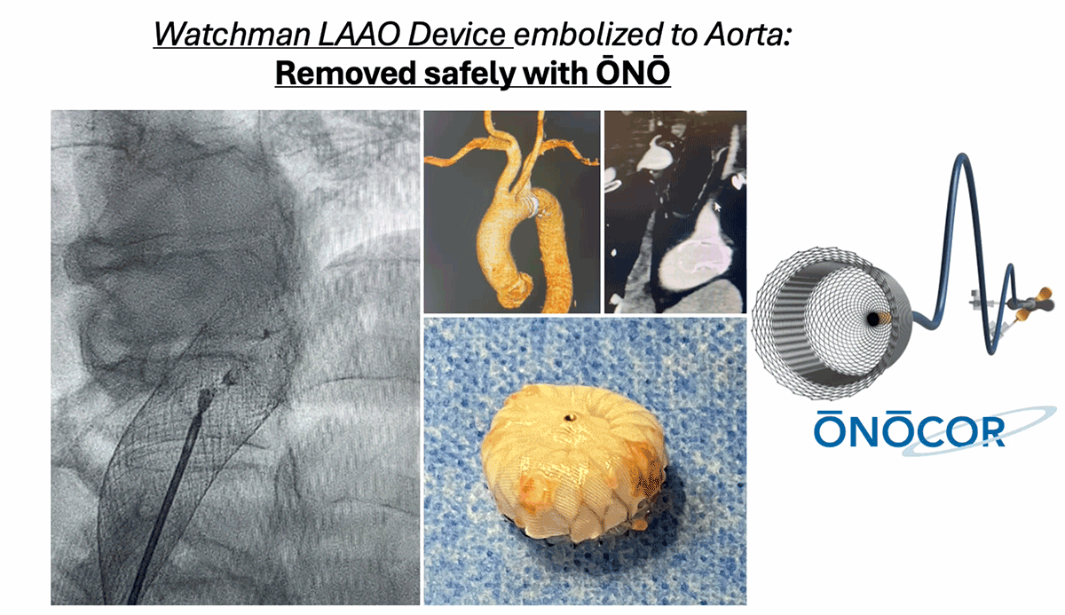 Preview image for Watchman removal from Aorta with ŌNŌ_MN