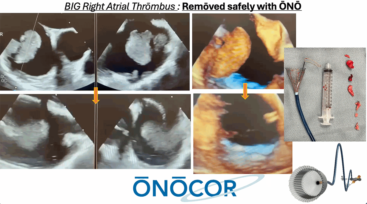 Preview image for Right Atrial Thrombus removal with ŌNŌ_PENN