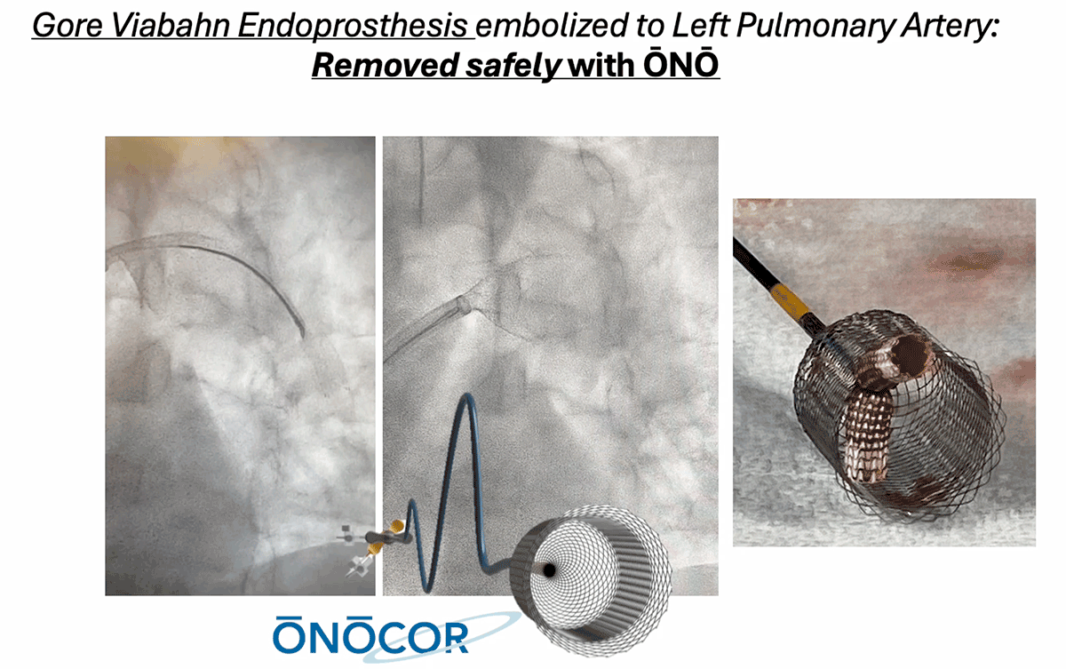 Preview image for Gore Viabahn Stent removed with ŌNŌ