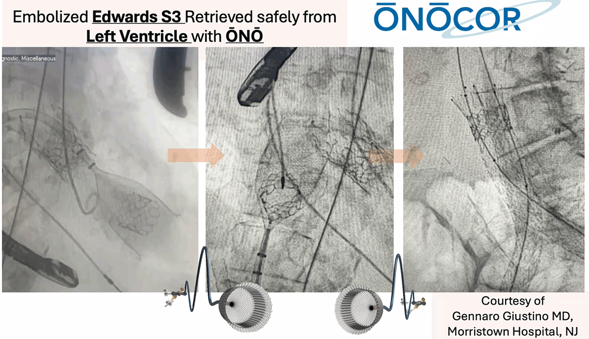 Preview image for Edwards Sapien S3 repositioned into IVC with ŌNŌ