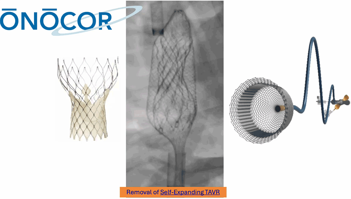 Preview image for Core Valve removed with ŌNŌ