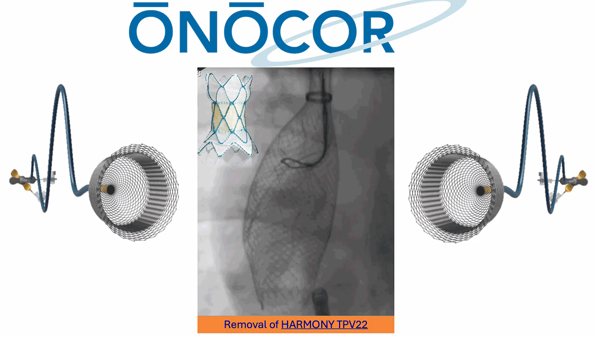 Preview image for Harmony TPV22 removed from Right Atrium