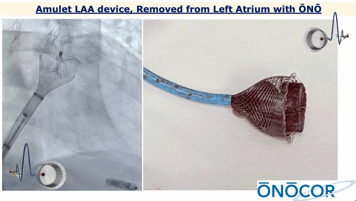 Abbott Amulet removed from Left Atrium with ŌNŌ