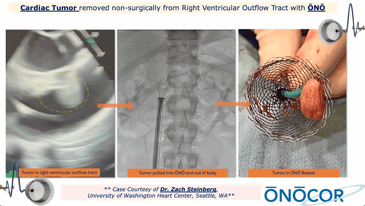 Preview image for RVOT Tumor removal with ŌNŌ_UW