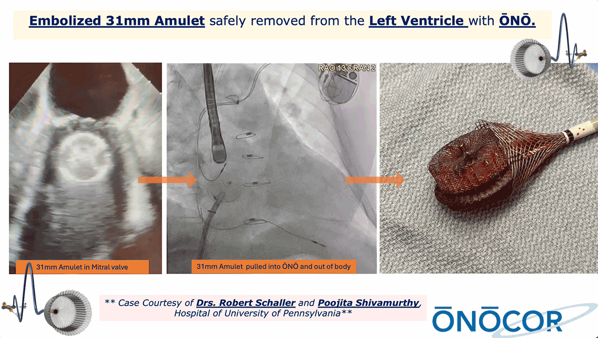 Preview image for 31mm Abbott Amulet removed from Left Ventricle with ŌNŌ