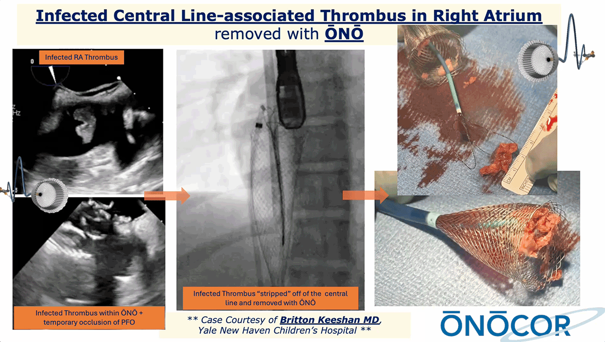 Preview image for Right atrial clot removal with ŌNŌ_Yale