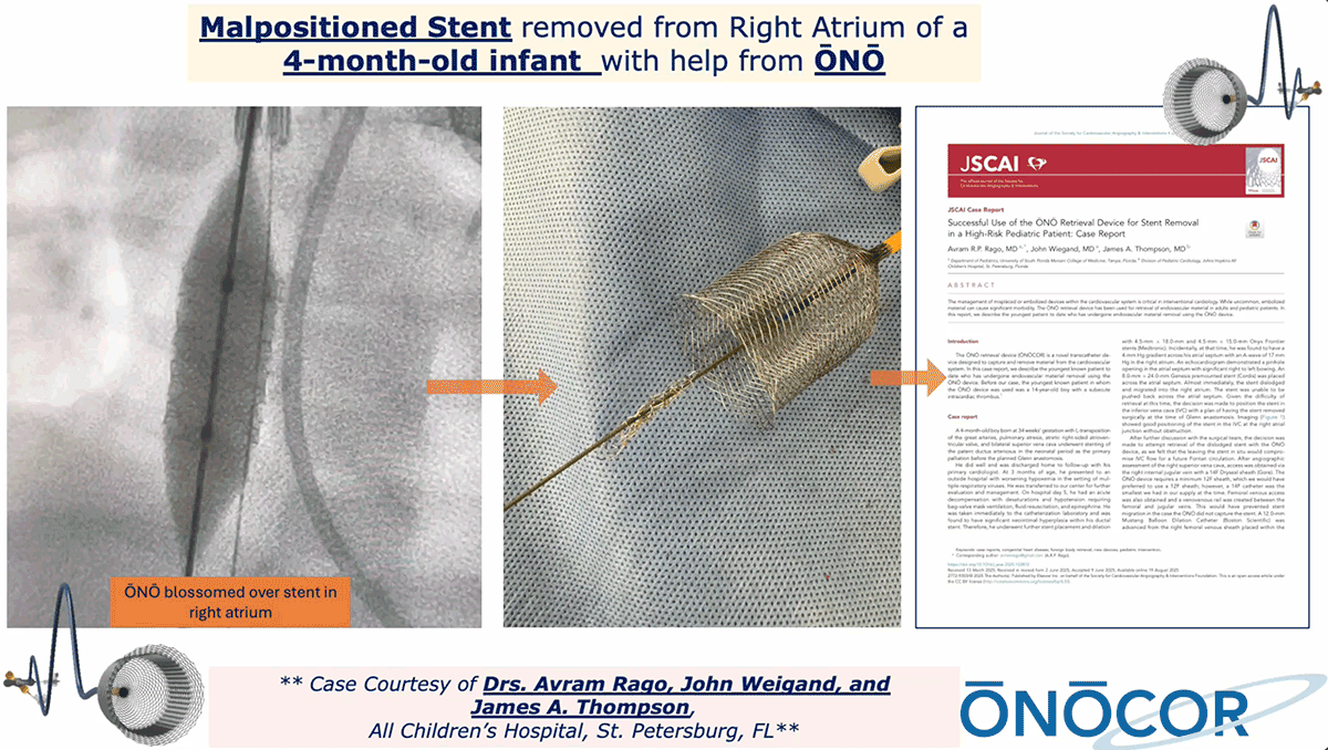 Preview image for Pediatric Stent removal with ŌNŌ