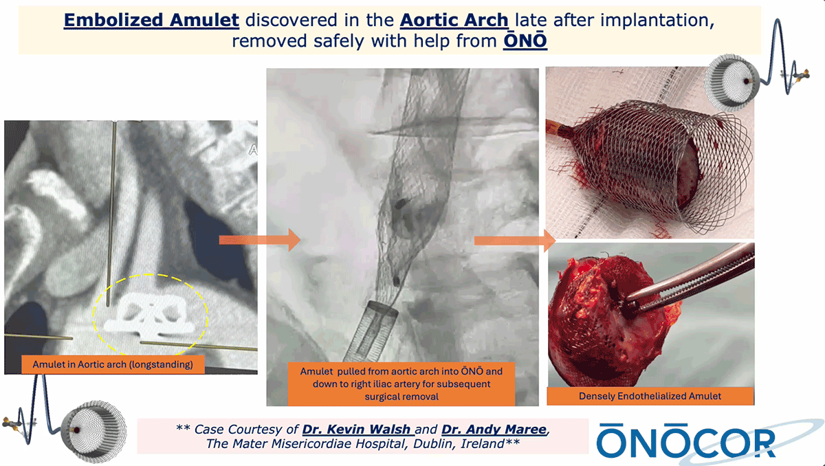 Preview image for Amulet removal from Aortic Arch WITH ŌNŌ_Dublin_9-2025