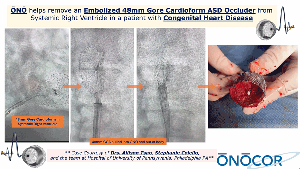 Preview image for 48mm GCA(Gore Cardioform Atrial Occluder) Removal 1 WITH ŌNŌ