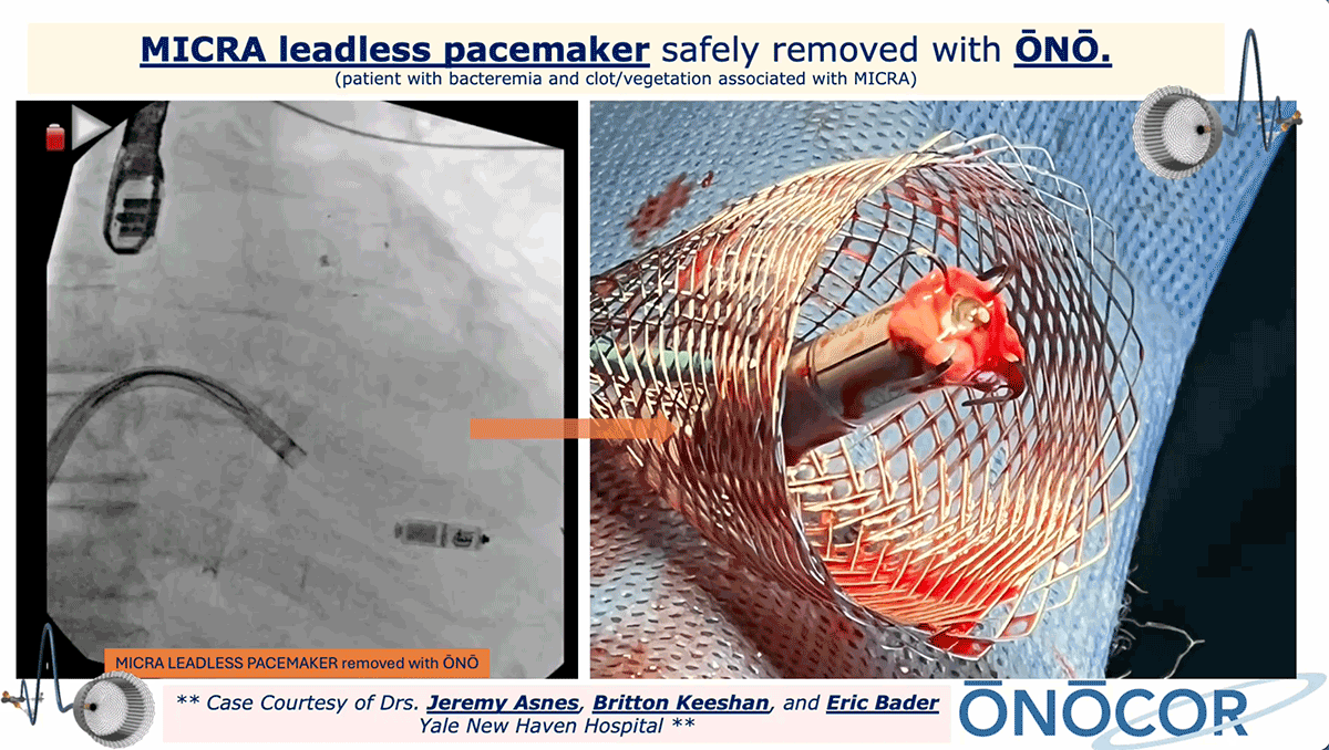 MICRA Leadless Pacemaker Removal with ŌNŌ