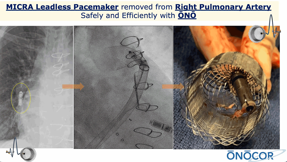Preview image for MICRA Leadless Pacemaker Removal 1 with ŌNŌ
