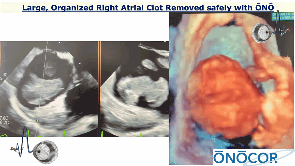Preview image for Large Right Atrial Clot removed with ŌNŌ