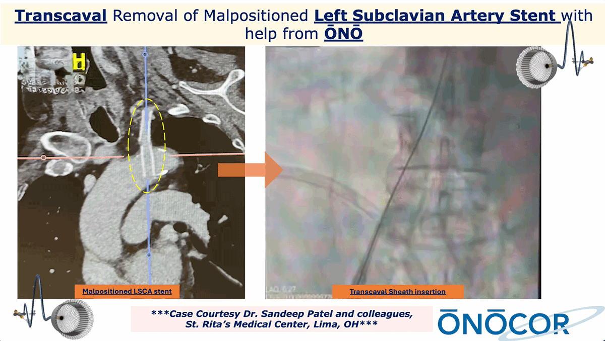 Preview image for Transcaval Stent removal with ŌNŌ
