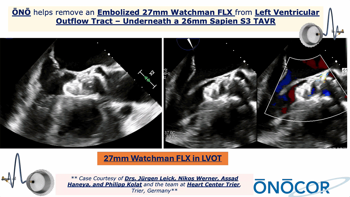 Preview image for 27mm Watchman removal from LVOT with ŌNŌ_Germany_10-2025