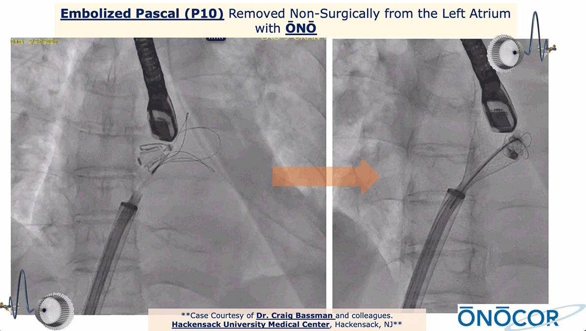 Preview image for Edwards Pascal P10 TEER Clip removed from Left Atrium with ŌNŌ