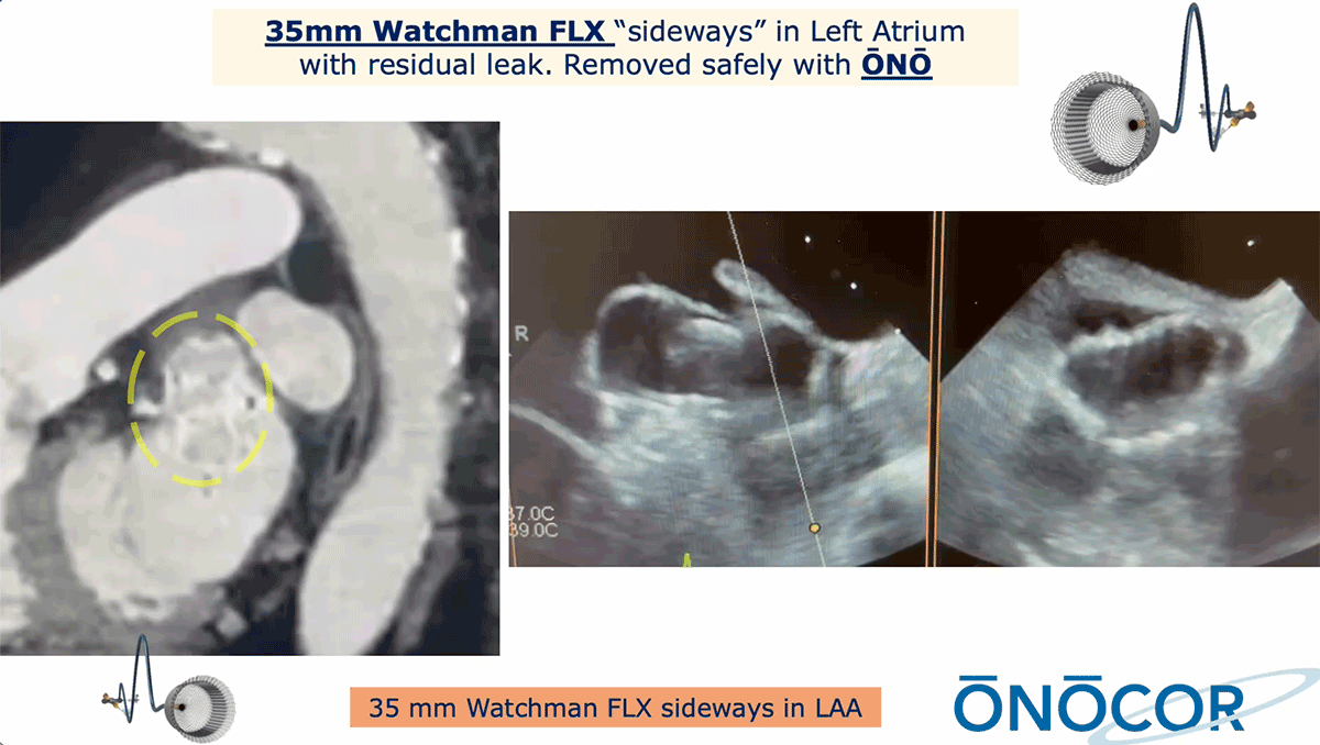 Preview image for 35mm Watchman removed from Left Atriumwith ŌNŌ_TX_2-2026