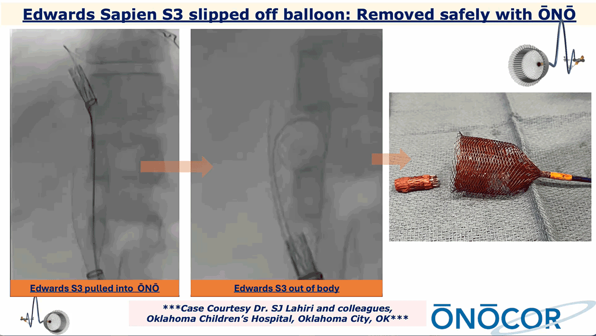 Preview image for Edwards Sapien S3 removed with ŌNŌ