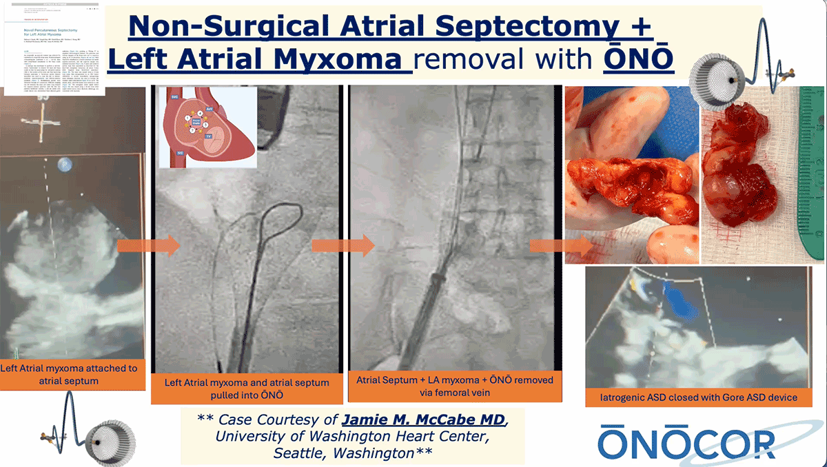 Preview image for Percutaneous Atrial Septectomy + Left Atrial Tumor removal with ŌNŌ
