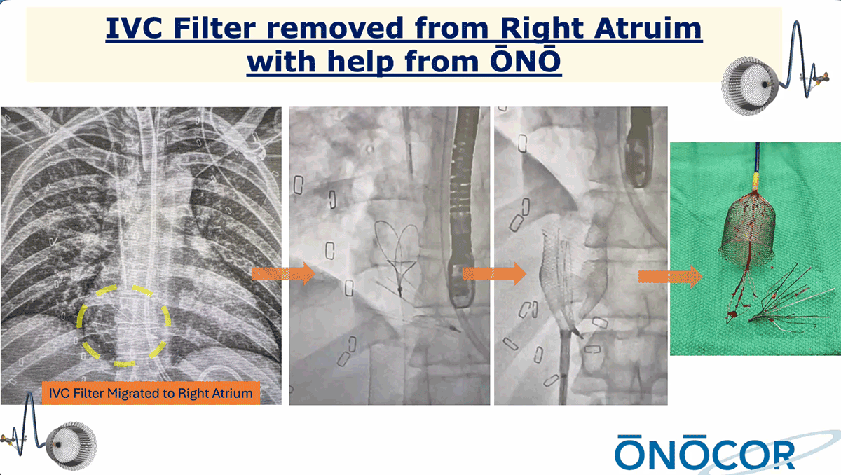 Preview image for IVC Filter removal with ŌNŌ