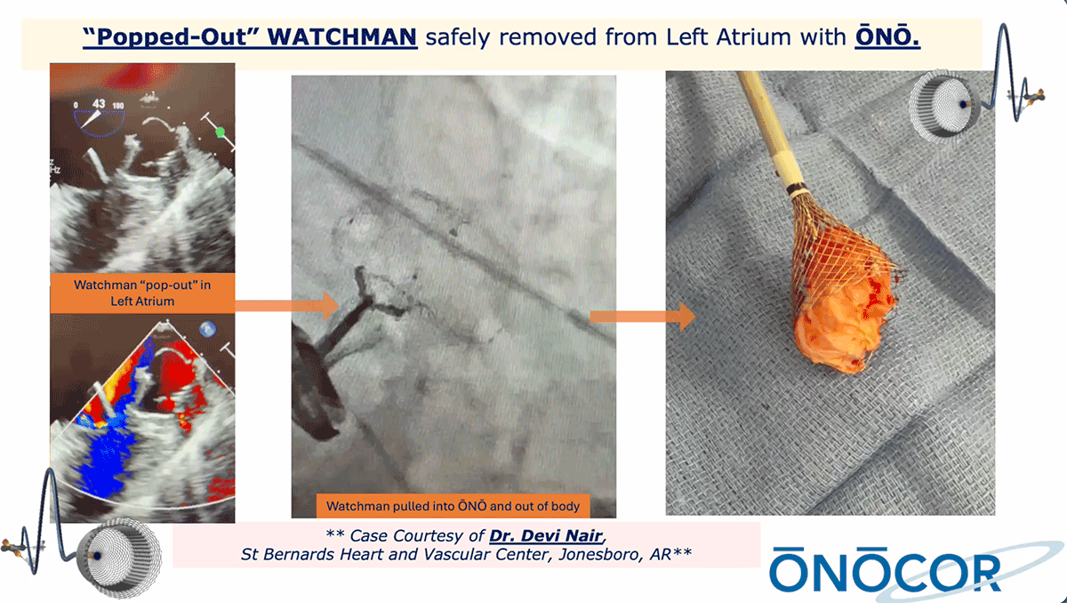 Preview image for Watchman removal from Left atirum with ŌNŌ_AR_10-2025