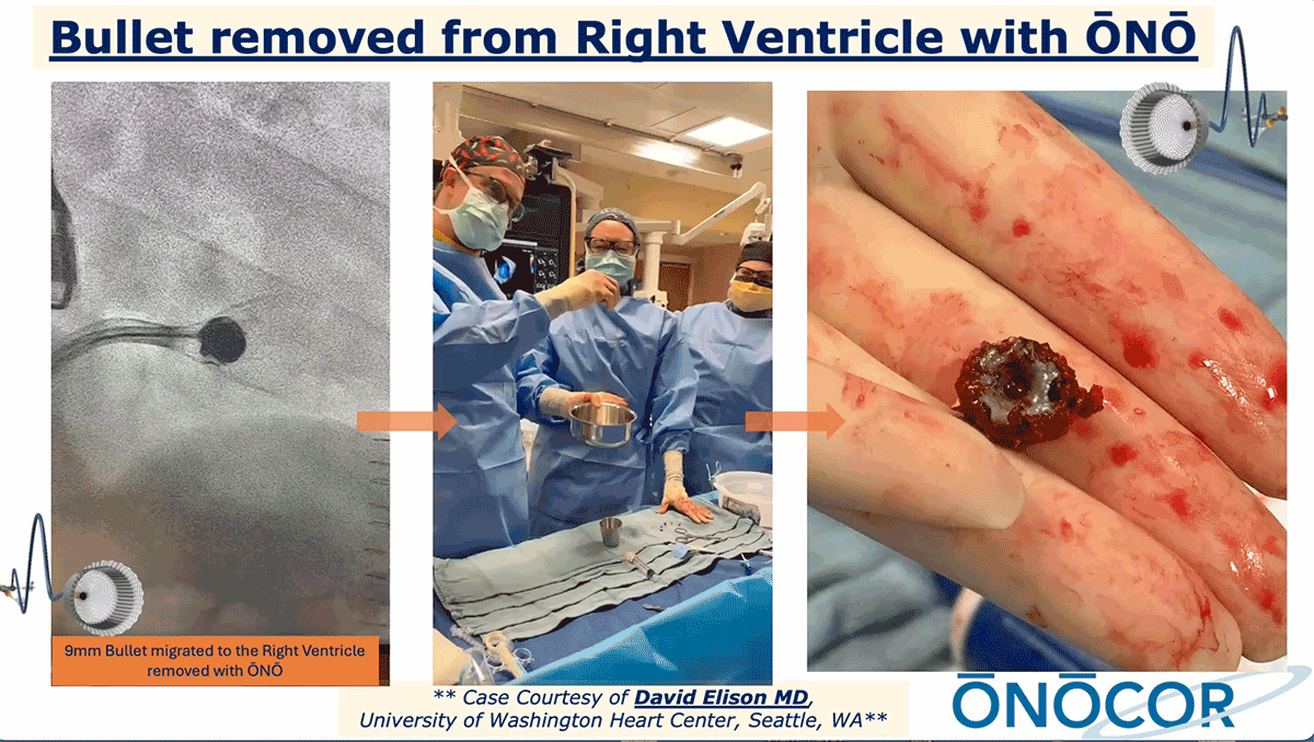Preview image for 9mm Bullet removed from Right Ventricle_UW