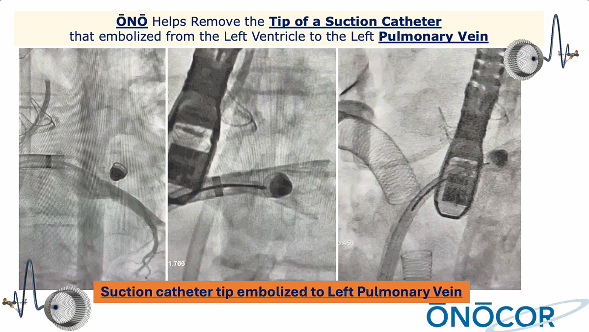 Preview image for Suction catheter fragment removal with ŌNŌ_VA